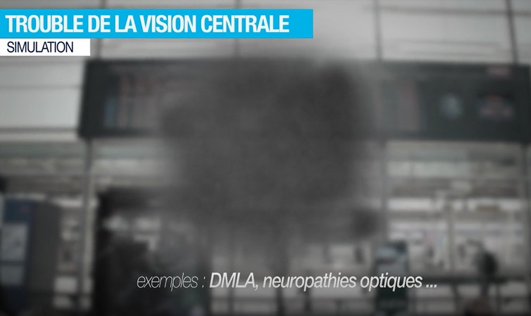 Ejemplo de alteración del campo visual central correspondiente a la visión de una persona con DMAE, neuropatía óptica hereditaria o distrofia de conos Ejemplo de alteración del campo visual central correspondiente a la visión de una persona con DMAE, neuropatía óptica hereditaria o distrofia de conos